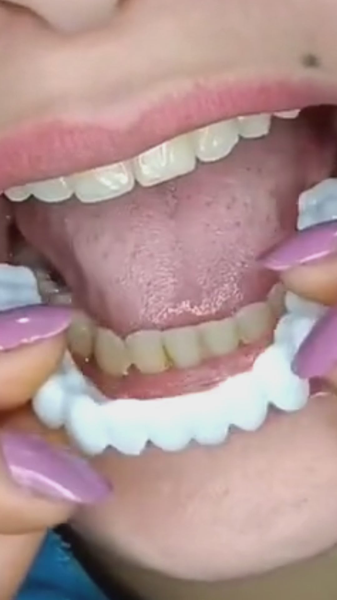 CARILLAS DENTALES SNAPON SMILE